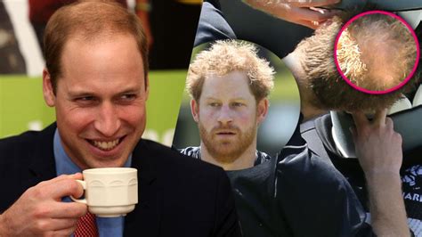 Prince Harry Going Bald After Years Of Poking Fun At Brother Prince