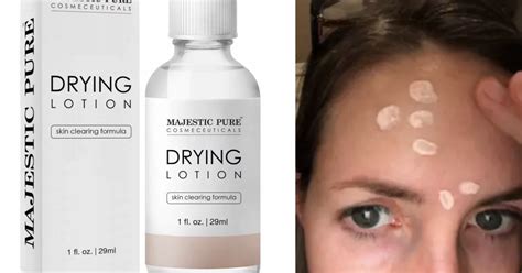 16 Of The Best Acne Spot Treatments You Can Get On Amazon Best Acne