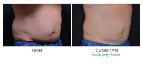 Before And After Coolsculpting Advanced Skin And Body Solutions