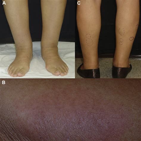 Pdf Sarcoidosis With Bilateral Leg Lymphedema As The Initial