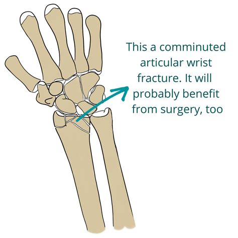 Wrist Fractures Distal Radius Fractures Pro Doctor