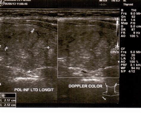 Thyroid Ultrasound Aspect Of Nodular Goiter Download Scientific Diagram