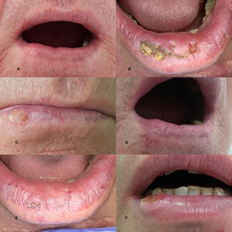 The Clinical Picture Of Actinic Cheilitis Ac C A Xerosis B