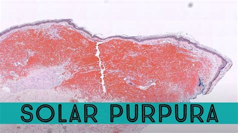 Solar Purpura Purple Bruise Like Areas On Elderly Sun Damaged Skin