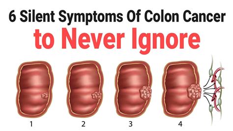 Colon Polyps As Related To Colorectal Cancer Pictures