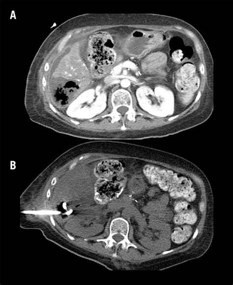 Abscess Formation Image A And Attempted Drain Placement Image B