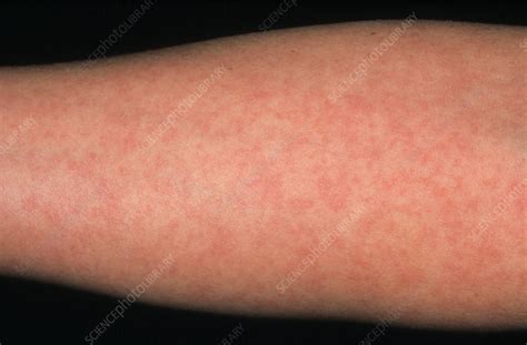Arm Of Woman Showing German Measles Rash Stock Image