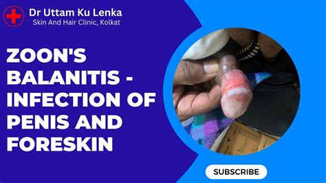 Zoon s Balanitis Infection of Penis and Foreskin Red spot on penis लग म ललदग Dr Uttam