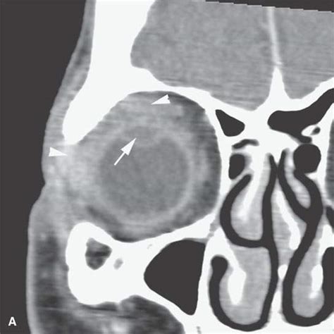 Lymphoma Radiology Key