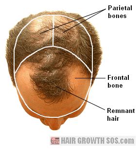 Why The Pattern In Male Pattern Baldness Develops Pattern Baldness