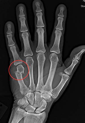 Boxers Fracture Mechanism Of Injury Signs Treatment