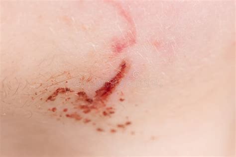 Wound On Human Skin Stock Image Image Of Macro Frayed 96573895
