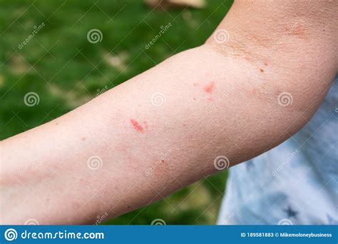 Poison Ivy Spots And Blisters On Woman`s Arm Stock Image Image Of