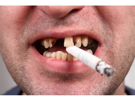 Does Smoking Reversely Affect Or Slow Down Orthodontic Treatments