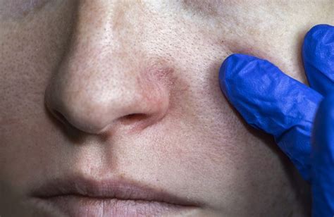 Facial Vein Treatment Options