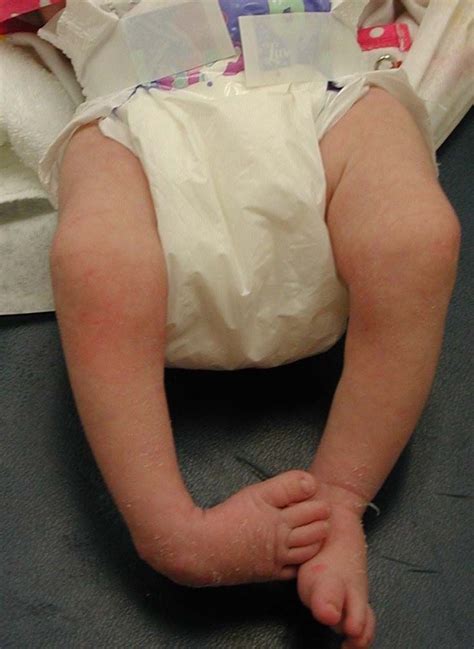 Description true clubfoot is characterized by abnormal bone formation in the foot. Clubfoot - OrthoInfo - AAOS