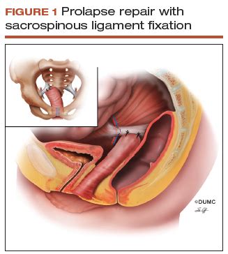 Optimal Surgical Management Of Stage And Pelvic Organ Prolapse