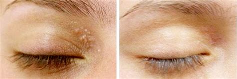 Acne Treatment & Milia Removal | Beauty Professionals