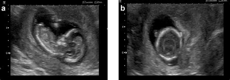 Prenatal Ultrasound Of The Fetus At 12 Weeks Of Gestation Shows A A