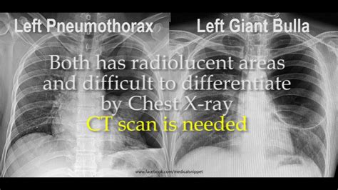 Pneumothorax Vs Bulla In Chest X Ray Youtube