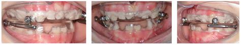 Children Free Full Text Intercepting Of Class Iii Malocclusion With