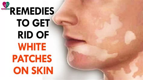 Remedies To Get Rid Of White Patches On Skin Health Sutra Youtube
