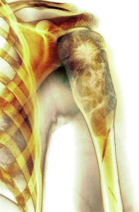Benign Bone Cyst Photograph By Mike Devlin Fine Art America