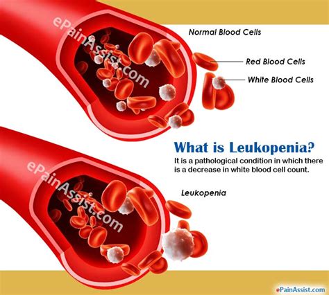 What Is Leukopenia And How Is It Treated