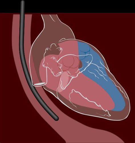 Transesophageal Echocardiography What Is It