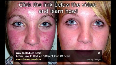 Watch Bio Oil Acne Scars Before And After Results Bio Oil Acne Scars