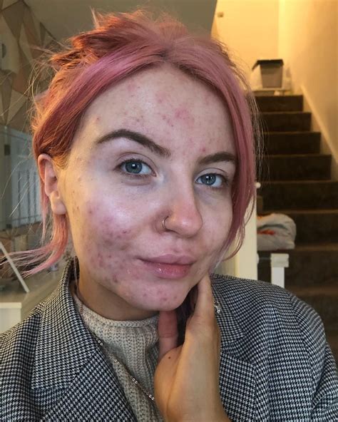 Beauty Blogger Abbie Shared A Before And After Makeup Post On Her