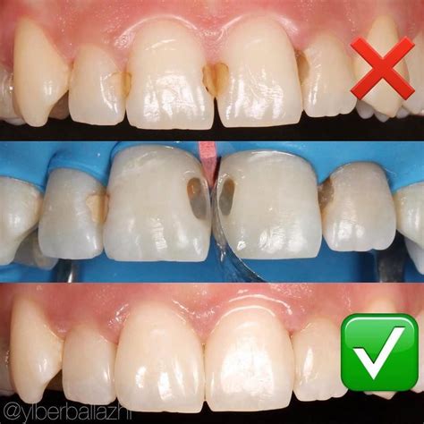 Some Lovely Front Teeth H White Fillings By Dr Ylberballazhi Great Work Doc Creating