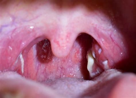 How To Know If You Have Tonsil Stones What Are Tonsil Stones And How