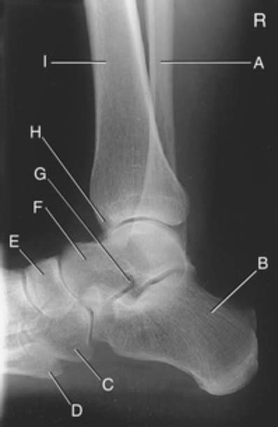 Lateral Ankle Radiograph Diagram Quizlet