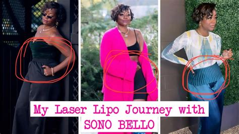I Am Getting Laser Lipo Trisculpt At Sono Bello Tomorrow 😱 Before