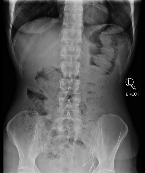 Signs and symptoms of bowel cancer. Large bowel obstruction secondary to colon cancer | Image ...
