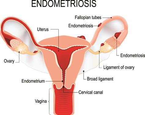 endometriosis and pregnant what now the pulse