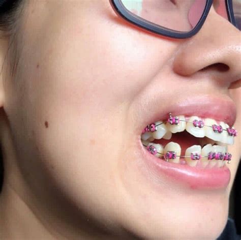 Pin On Glasses And Braces