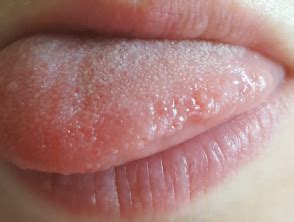 Swollen Bumps On Tongue Side My XXX Hot Girl