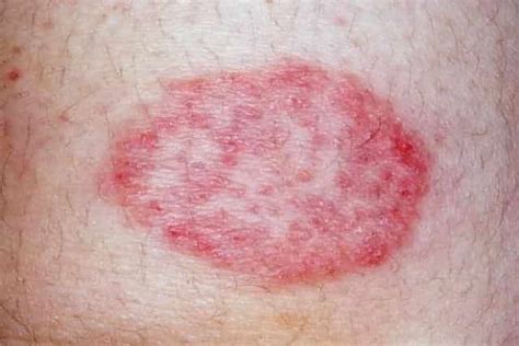 Red Spots On Skin Patches Small Tiny Pinpoint Not Itchy Pictures