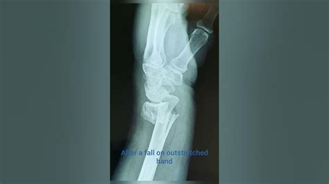 Distal Radius Fracture With Radioulnar Dislocation Youtube