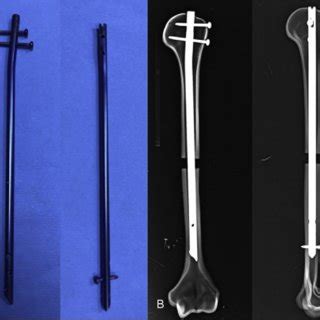 Fractures of the humerus are common at the surgical neck. A: In group 1, rotational failure was caused by a spiral fracture in... | Download Scientific ...