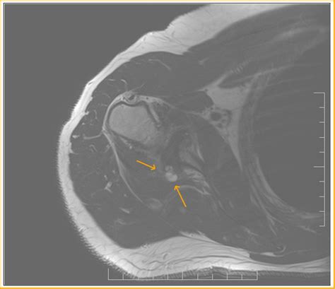 Reverse Hill Sachs Lesion Mri Sumers Radiology Blog