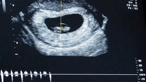 Kristan S First Ultrasound 7 Weeks 4 Days