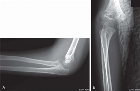 Supracondylar Humerus Fracture Types