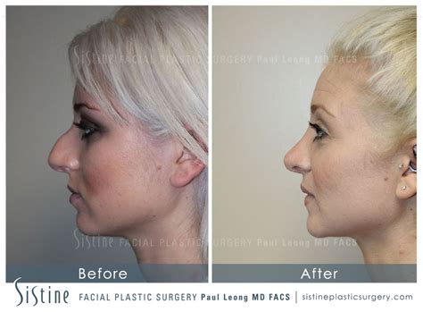 Nose Before And After 20 Sistine Facial Plastic Surgery