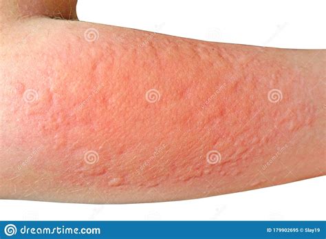 Dermatitis Ill Allergic Rash Dermatitis Or Eczema Skin On The Legs
