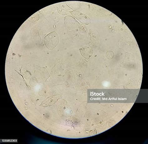 소변 현미경 40x 이미지에 있는 상피 세포 소변에 대한 스톡 사진 및 기타 이미지 소변 현미경 진균증 Istock