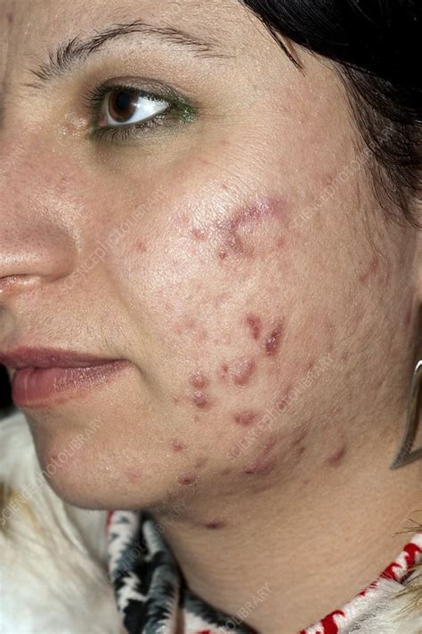 Acne Vulgaris Stock Image C0024056 Science Photo Library