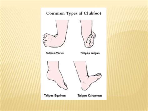Club foot often affects the forelimbs in most cases, whereby the hoof has a deformed shape, making walking difficult or painful. Club foot